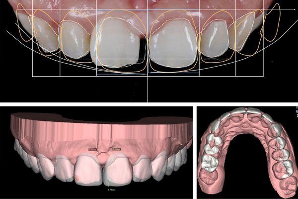 diseño-de-sonrisas-barcelona-dsd