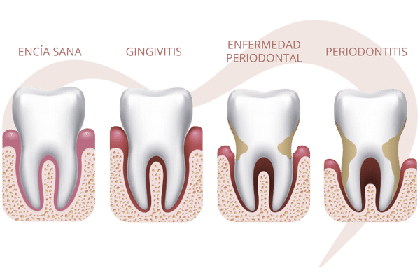 enfermedad-periodontal-tratamientos-barcelona