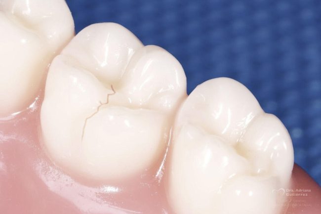 estetica-dental-para-fisuras-dentales-barcelona
