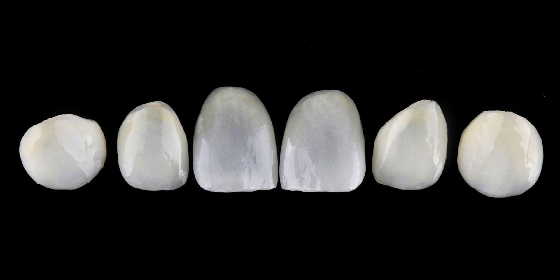 carillas-dentales-porcelana-vs-carillas-disilicato carillas-dentales-porcelana-vs-carillas-disilicato