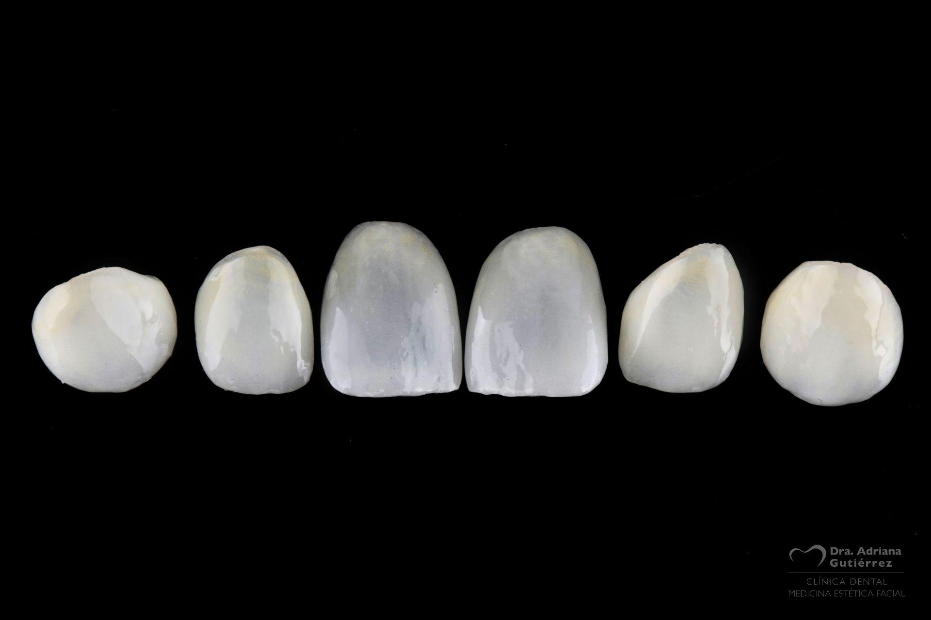 Tipos de carillas dentales, ventajas, cuidados y mantenimiento