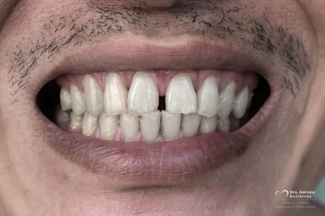 diastemas-como-corregirlos-Dental-Adriana-Barcelona