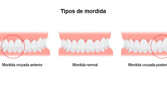 tipos-mordida-cruzada