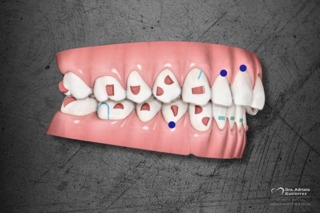 clincheck-ortodoncia-invisible-invisalign