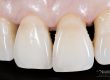 recesion-gingival