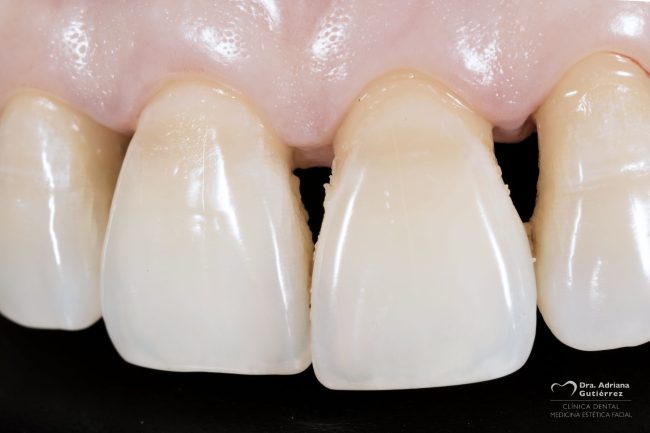 recesion-gingival