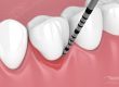 Tratamiento de la periodontitis