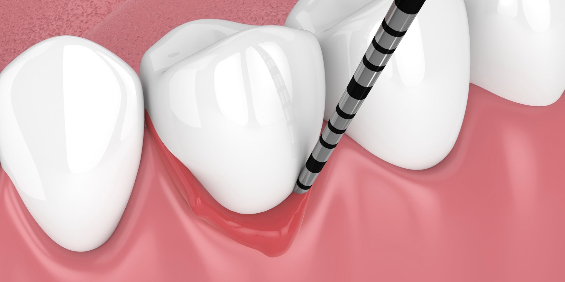 Tratamiento de la periodontitis