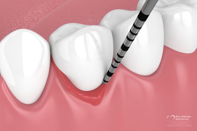 Tratamiento de la periodontitis