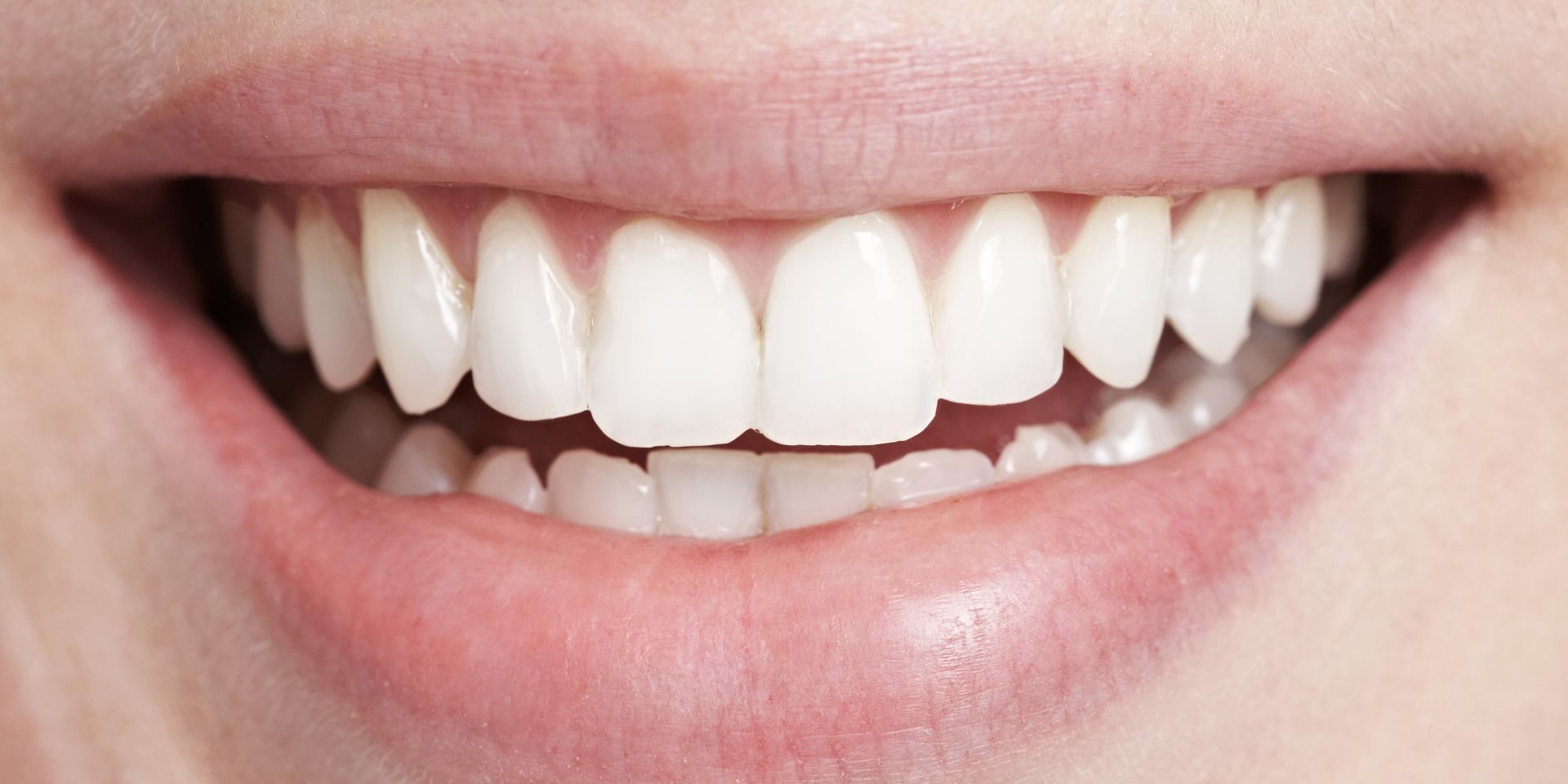 tratamiento de bonding dental