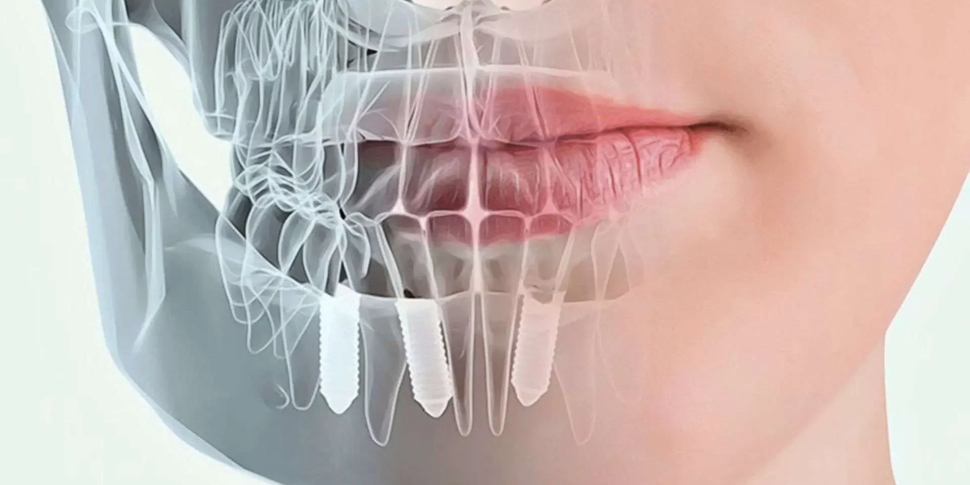 cirugia-guiada-para-implantes-dentales-barcelona-dental-adriana Cirugía guiada para implantes dentales