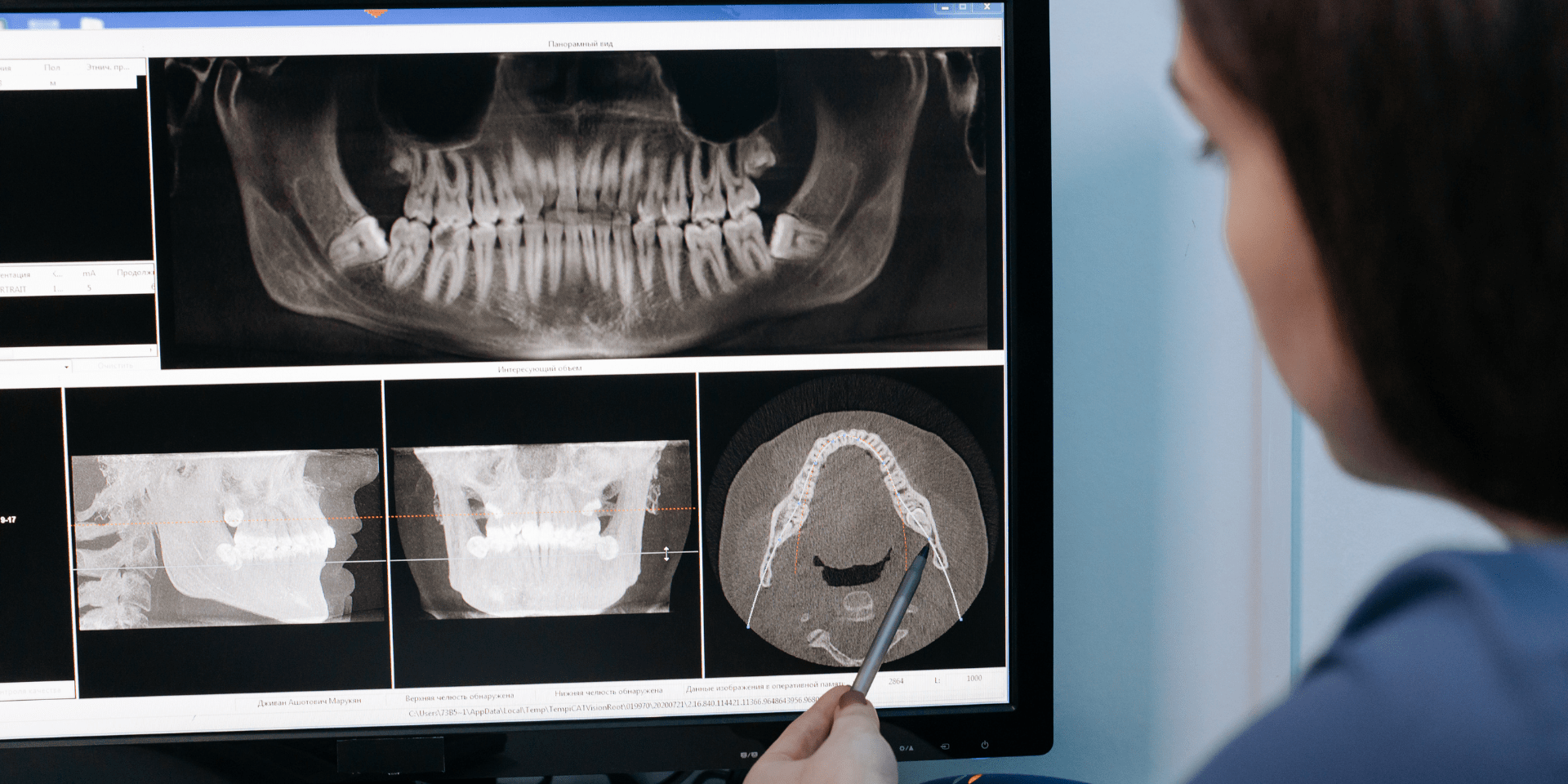 planificación implantes