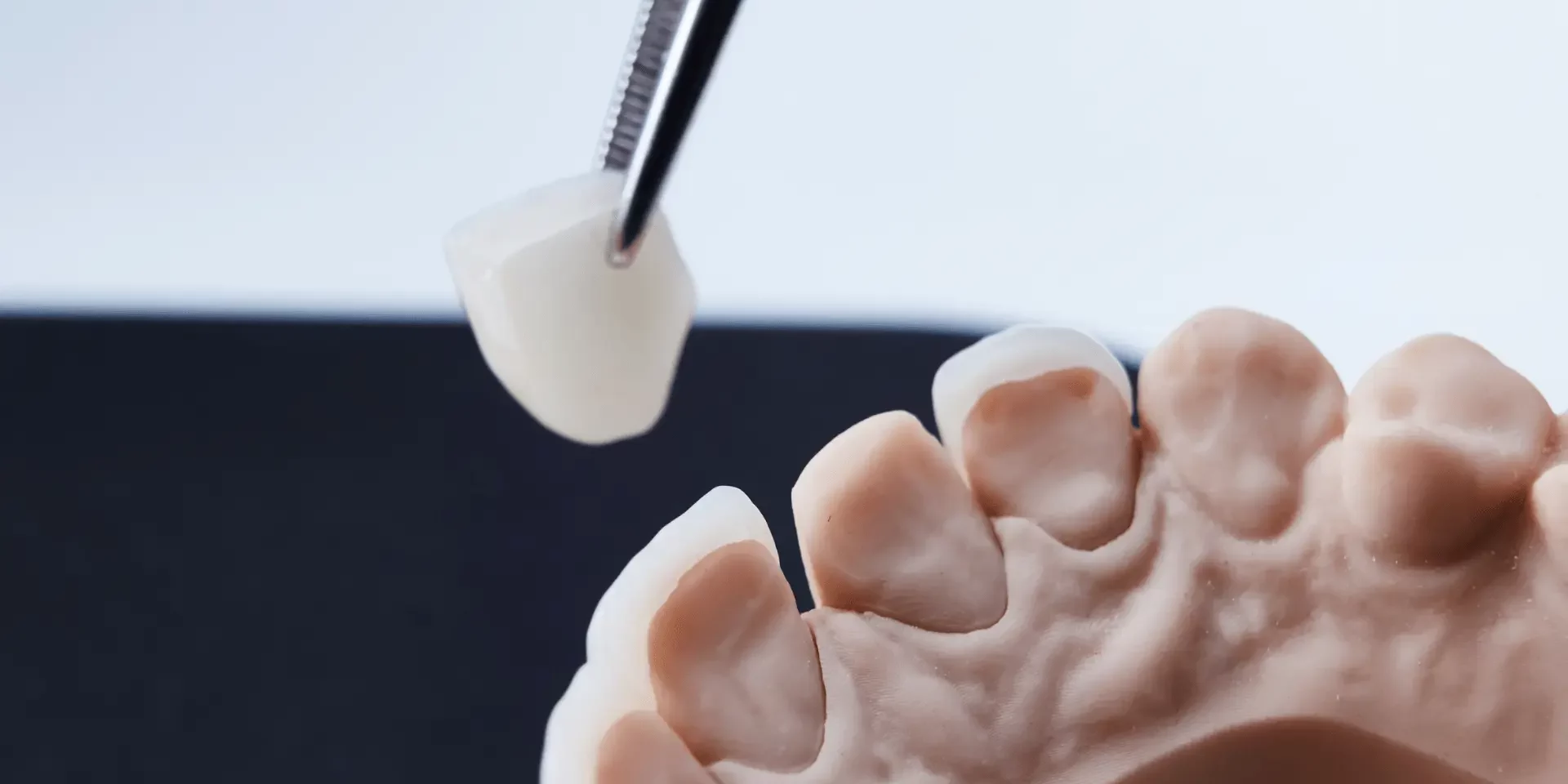 carilla dental sin tallado colocada sobre diente natural para mejorar la estética