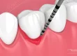 Apiñamiento dental que dificulta la higiene y favorece la inflamación de las encías