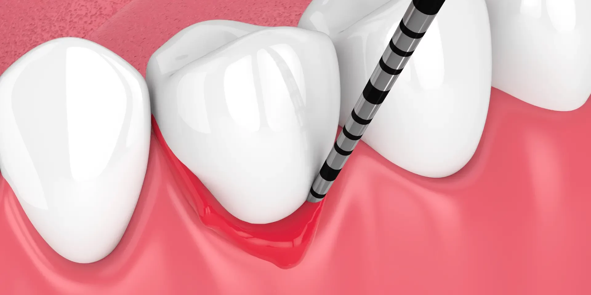 Apiñamiento dental que dificulta la higiene y favorece la inflamación de las encías