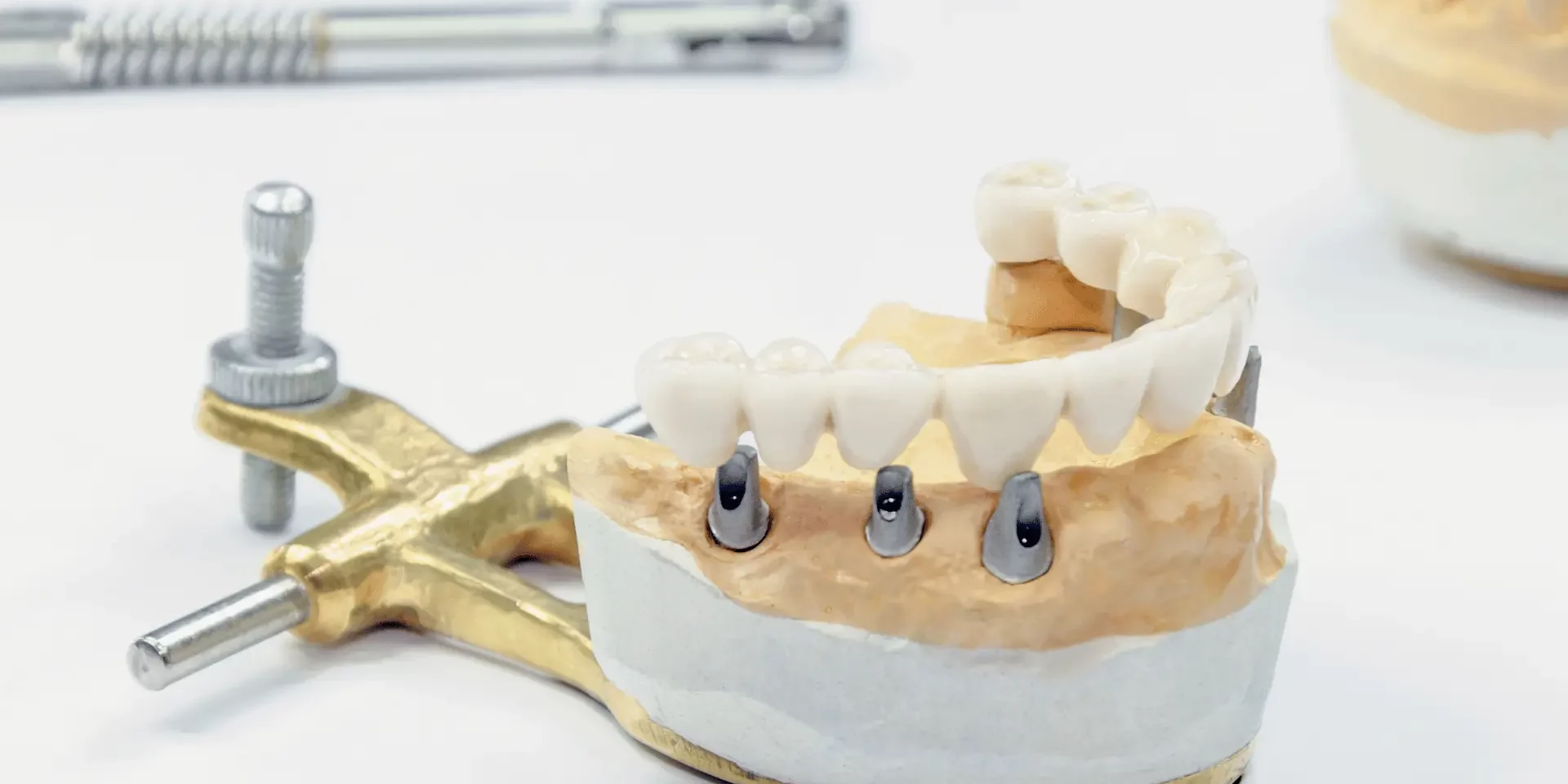 prótesis fija sobre implantes dentales all on six en modelo dental