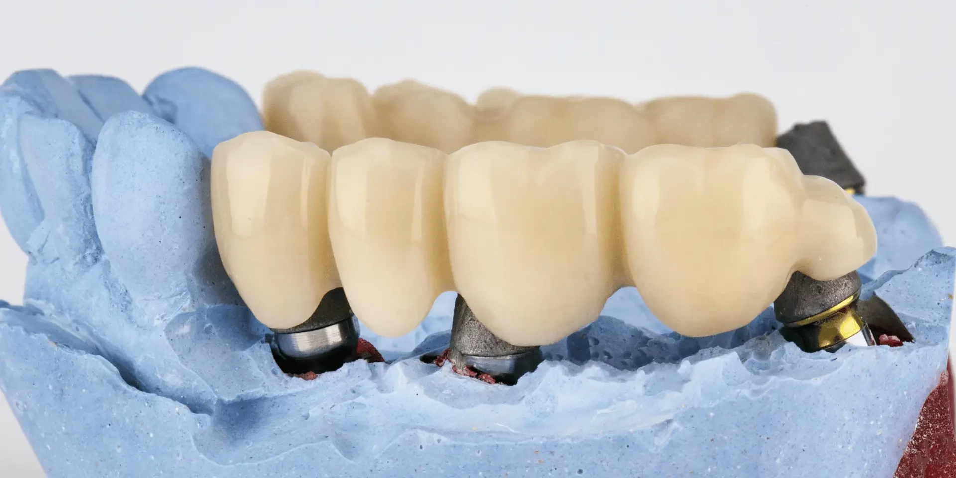 Puente dental fijo sobre implantes para sustituir dientes perdidos