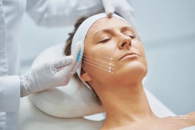 Tratamiento facial con hilos tensores para reafirmar y tensar la piel