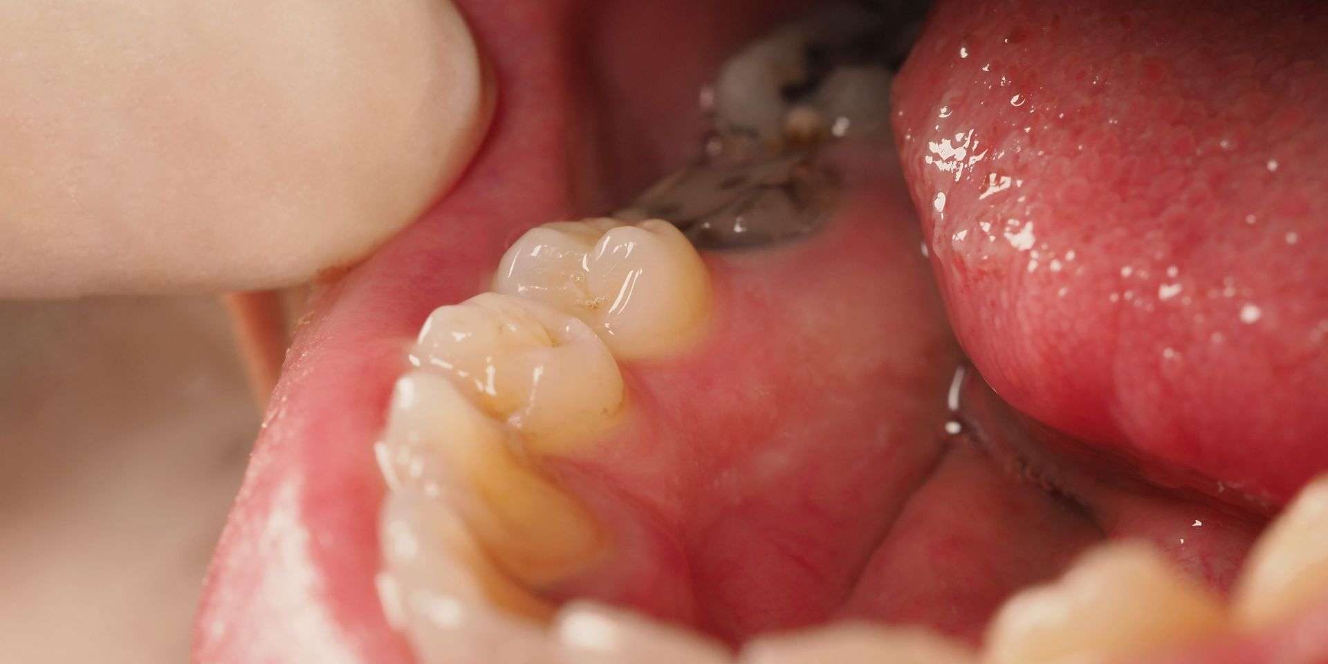 Caries profundas