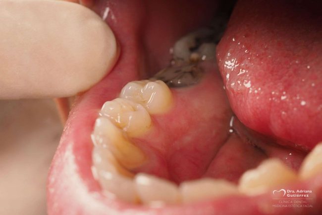 Caries profundas
