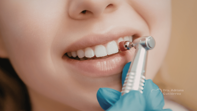 stripping dental