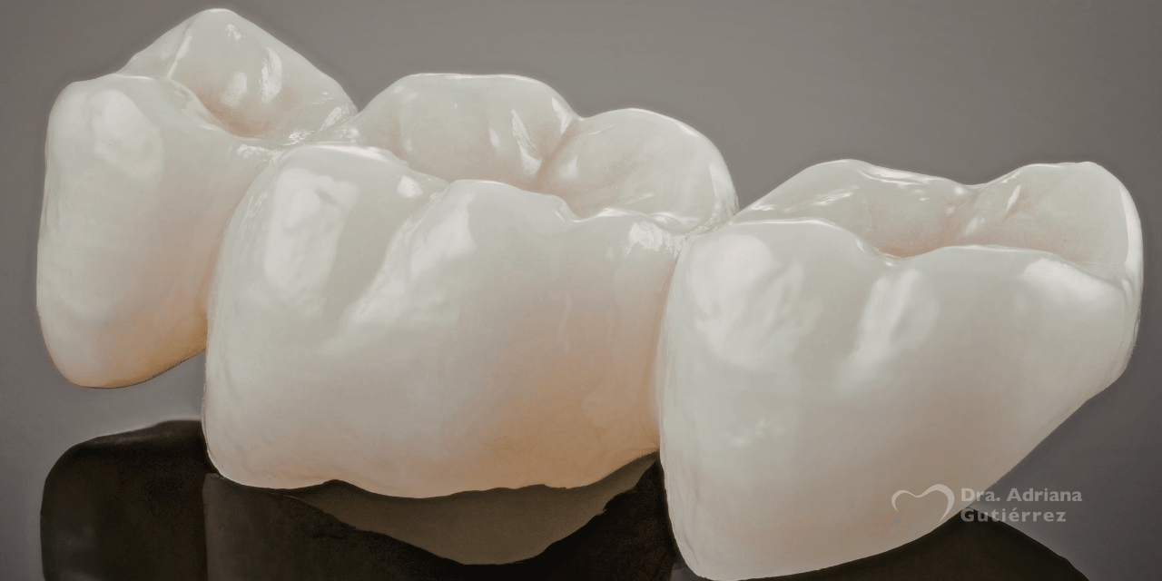 tipos de coronas dentales