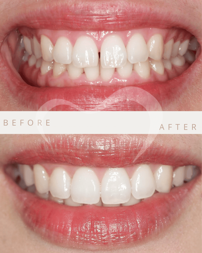 antes despues carillas composite antes despues carillas composite