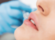 Sonrisa gingival y perfilado de labios