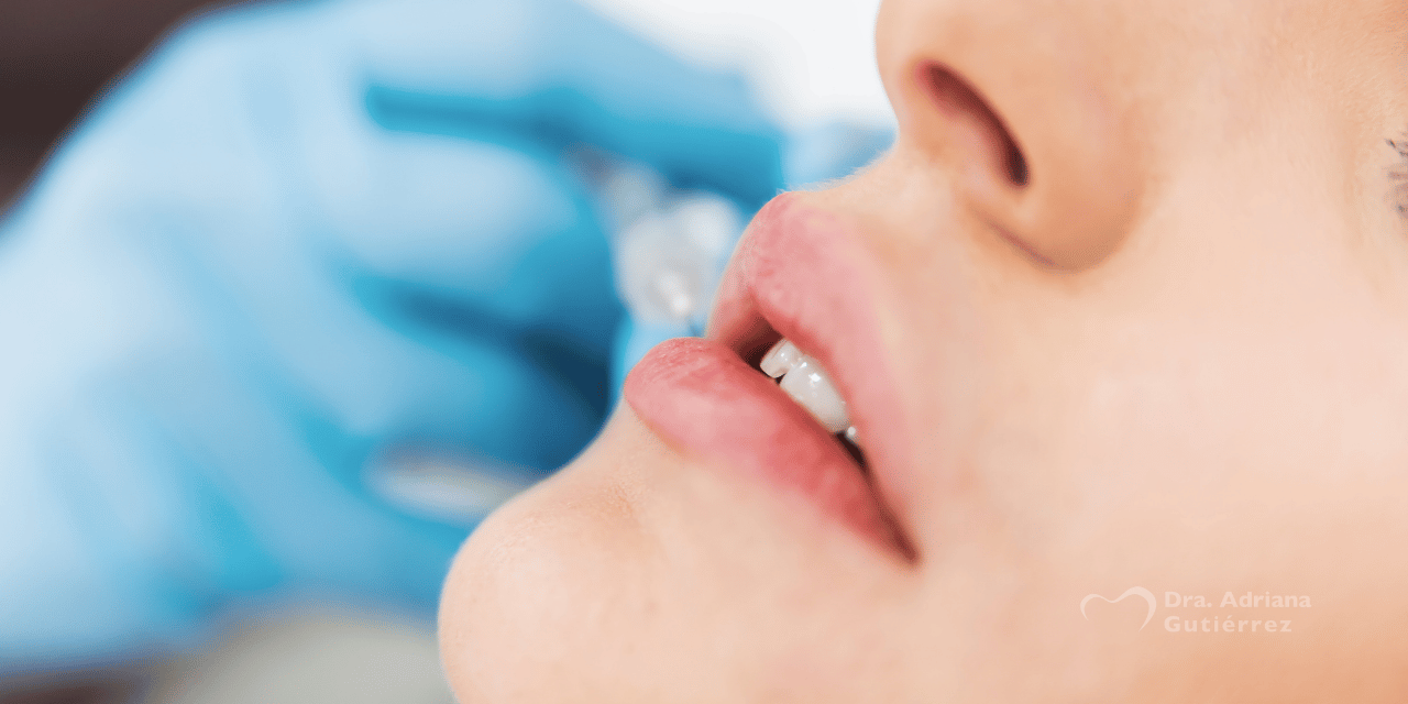 Sonrisa gingival y perfilado de labios Sonrisa gingival y perfilado de labios