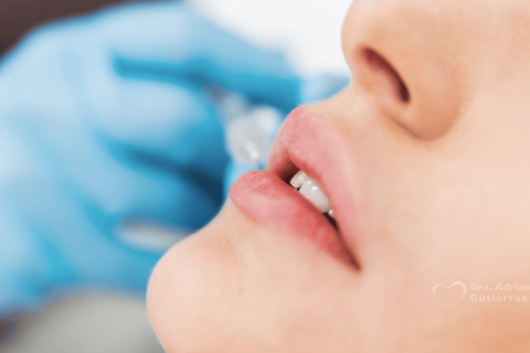 Sonrisa gingival y perfilado de labios