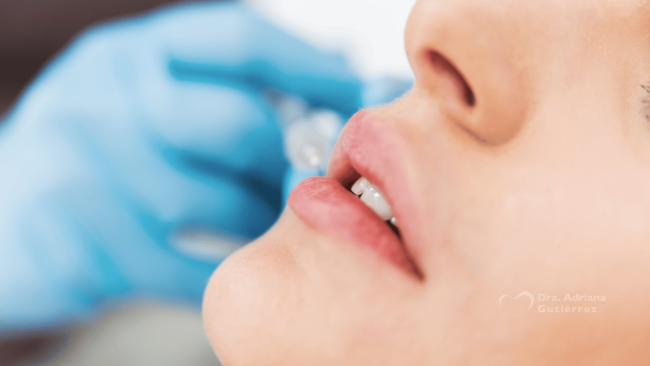 Sonrisa gingival y perfilado de labios