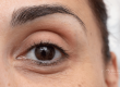 tratamiento ojeras