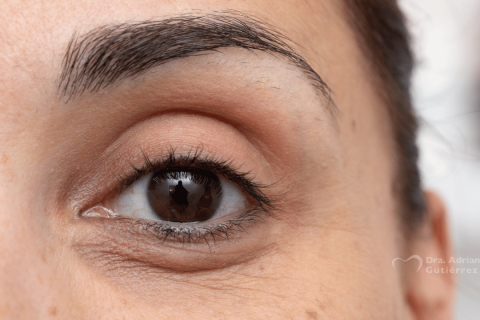 tratamiento ojeras