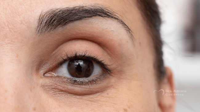 tratamiento ojeras